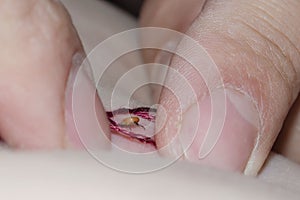 Man removing a tick from skin