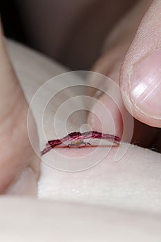 Man removing a tick from skin