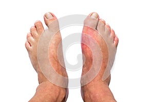 Man with right foot swollen and painful gout inflammation isolated on white background