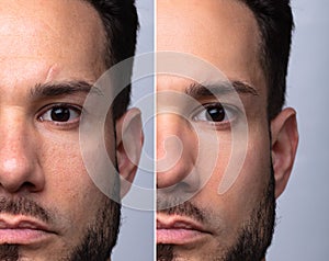 Man`s Face Before And After Cosmetic Procedure