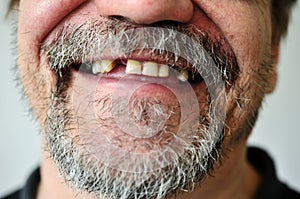 Man's face with a smiling toothless photo