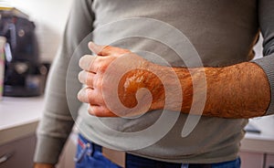 A man's hand burned with boiling water. On it there are redness and blisters