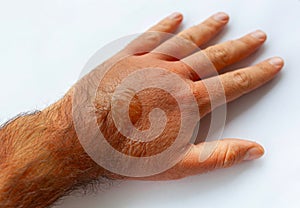 A man's hand burned with boiling water. On it there are redness and blisters