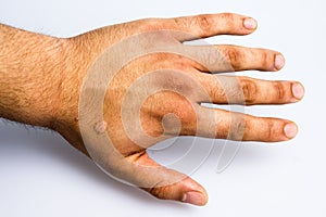 Man's hand with scar from cigarette burn