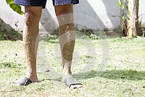 Man`s legs were dirty with grass clippings. because he wears shorts to mow the grass on the lawn without wearing protective clot