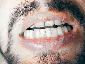 A man`s mouth with white teeth and grown bristles over his lip and chin. Close-up photos