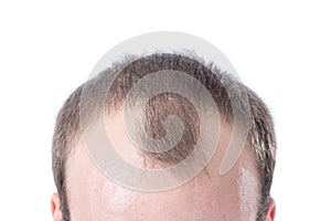 Man's Receding Hairline photo