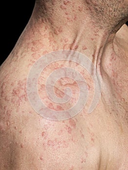 Man's Shoulder Covered With Skin Allergy