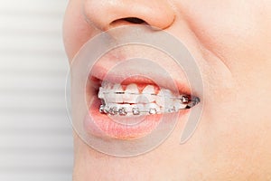 Man`s smile with dental braces on teeth photo