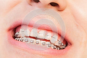 Man`s smile with orthodontic braces photo