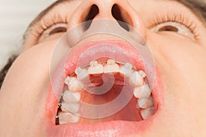 Man`s wide opened mouth with dental braces photo