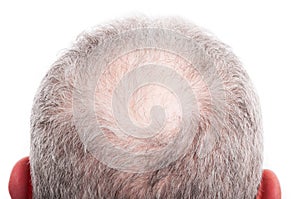 Man scalp with hair loss problem