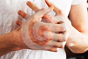 Man scratch oneself, dry flaky skin on hand with psoriasis vulgaris, eczema and other skin conditions like fungus photo