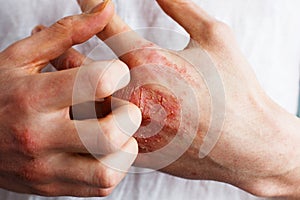 Man scratch oneself, dry flaky skin on hand with psoriasis vulgaris, eczema and other skin conditions like fungus photo