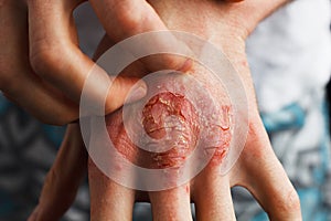 Man scratch oneself, dry flaky skin on hand with psoriasis vulgaris, eczema and other skin conditions like fungus