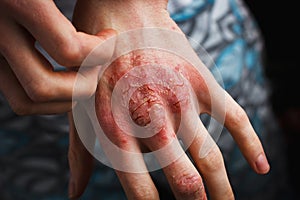 Man scratch oneself, dry flaky skin on hand with psoriasis vulgaris, eczema and other skin conditions like fungus