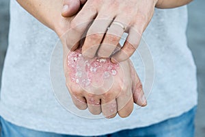 Man scratch oneself, dry flaky skin on hand with psoriasis vulgaris, eczema and other skin conditions like fungus, plaque, rash an