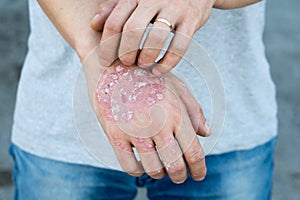 Man scratch oneself, dry flaky skin on hand with psoriasis vulgaris, eczema and other skin conditions like fungus, plaque, rash an photo