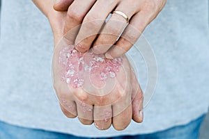 Man scratch oneself, dry flaky skin on hand with psoriasis vulgaris, eczema and other skin conditions like fungus, plaque, rash an