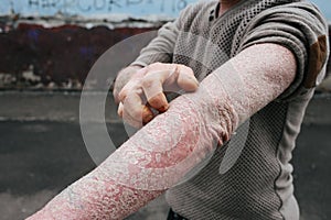 The man scratches his hands covered with psoriasis, which itch very much and his joints hurt, the concept of psoriasis