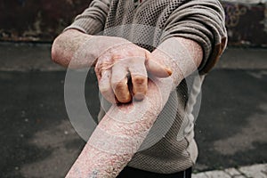 The man scratches his hands covered with psoriasis, which itch very much and his joints hurt, the concept of psoriasis