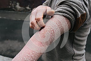 The man scratches his hands covered with psoriasis, which itch very much and his joints hurt, the concept of psoriasis