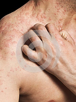 Man Scratching Allergic Skin photo