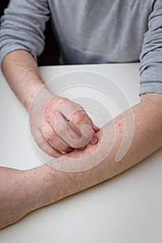 Man scratching his arm with red itchy rash, allegry, dermatitis or other skin illness with painful symptoms. Dermatology and skin