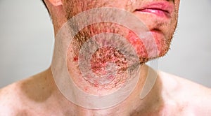 Man with seborrheic dermatitis in the beard area photo