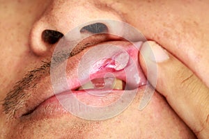 Man with serious aphtha