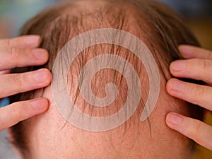 Man showing hair loss on his head