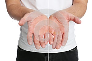 Man showing hands without and with calluses on white background., closeup. Collage photo