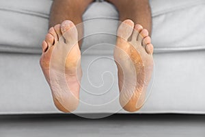 Man showing his peeling and cracked foot. Fungal infection. Health care concept photo