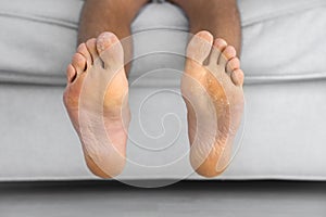 Man showing his peeling and cracked foot. Fungal infection. Health care concept