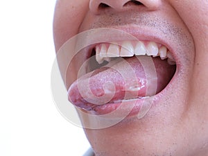 Man Showing His Sprue In Tongue