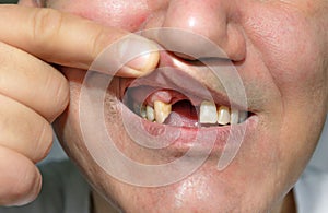 Man showing mouth without teeth
