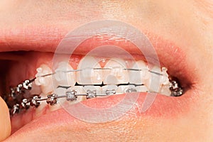 Man showing orthodontics and bite correction photo