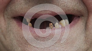 A man shows his rotten teeth. Periodontal disease. Sawn teeth before prosthetics. Teeth with caries.