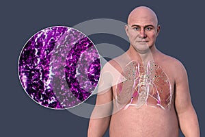 Man with silicosis, 3D illustration and light micrograph