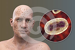 A man with smallpox disease and close-up view of variola virus, a virus from Orthopoxviridae family that causes smallpox photo