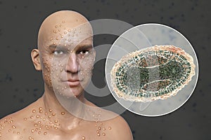 A man with smallpox disease and close-up view of variola virus, a virus from Orthopoxviridae family that causes smallpox photo