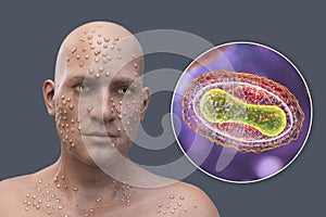 A man with smallpox disease and close-up view of variola virus, a virus from Orthopoxviridae family that causes smallpox