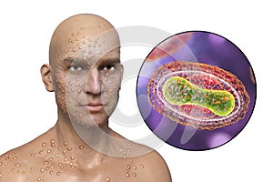 A man with smallpox disease and close-up view of variola virus, a virus from Orthopoxviridae family that causes smallpox