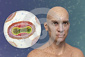 A man with smallpox disease and close-up view of variola virus, a virus from Orthopoxviridae family that causes smallpox