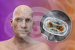 A man with smallpox disease and close-up view of variola virus, a virus from Orthopoxviridae family that causes smallpox