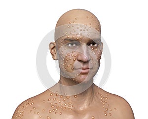 A man with smallpox disease photo