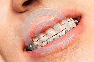 Man smiling showing dental braces photo
