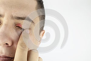 A man stands in front of a mirror and sees inflammation of the upper eyelid. Redness of the skin around the eyes and blepharitis