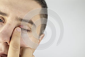 A man stands in front of a mirror and sees inflammation of the upper eyelid. Redness of the skin around the eyes and blepharitis