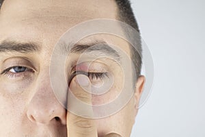 A man stands in front of a mirror and sees inflammation of the upper eyelid. Redness of the skin around the eyes and blepharitis